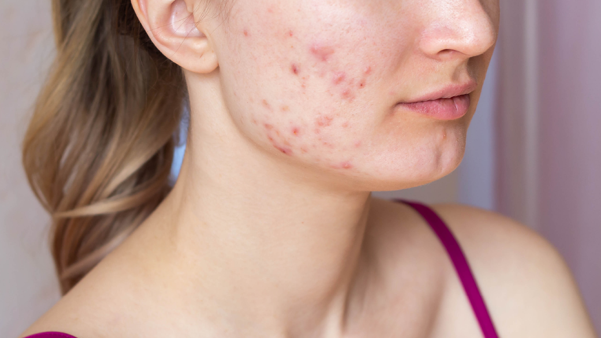 Akne Vulgaris, Akne Rosacea