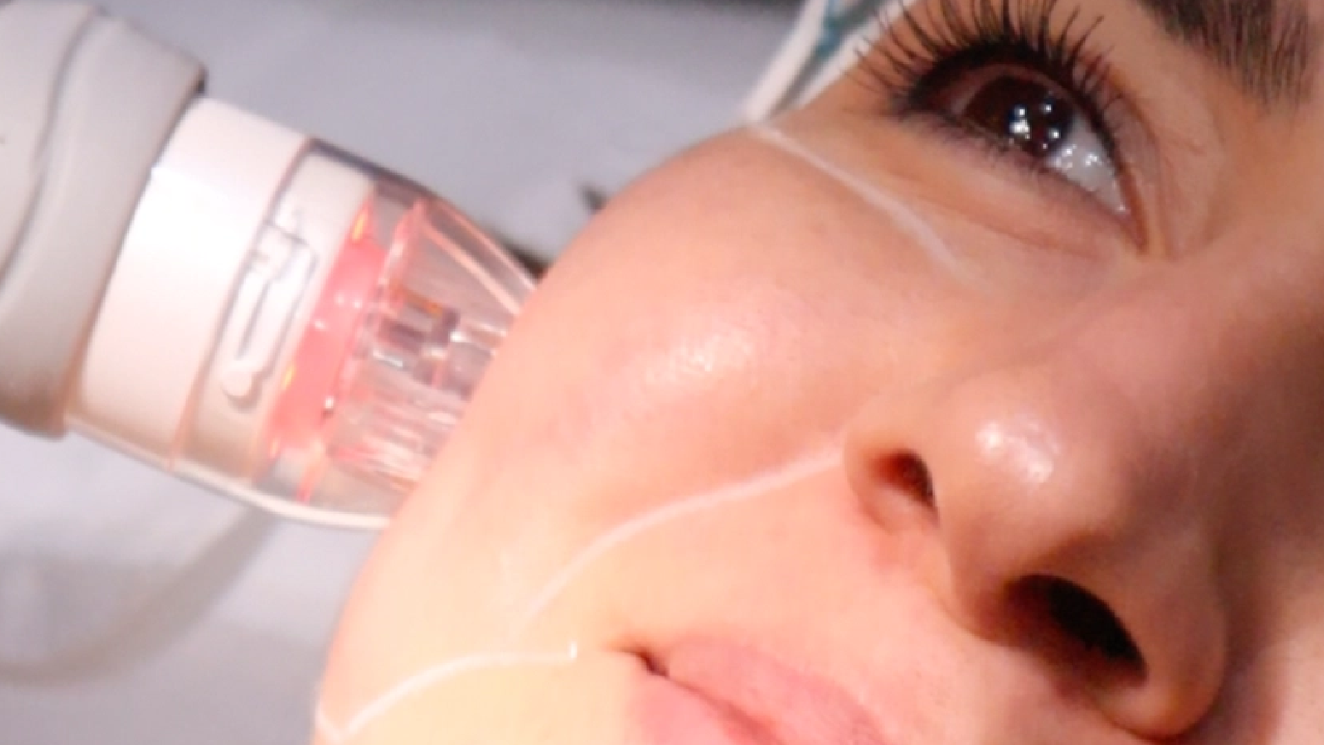 Altın İğne Tedavisi