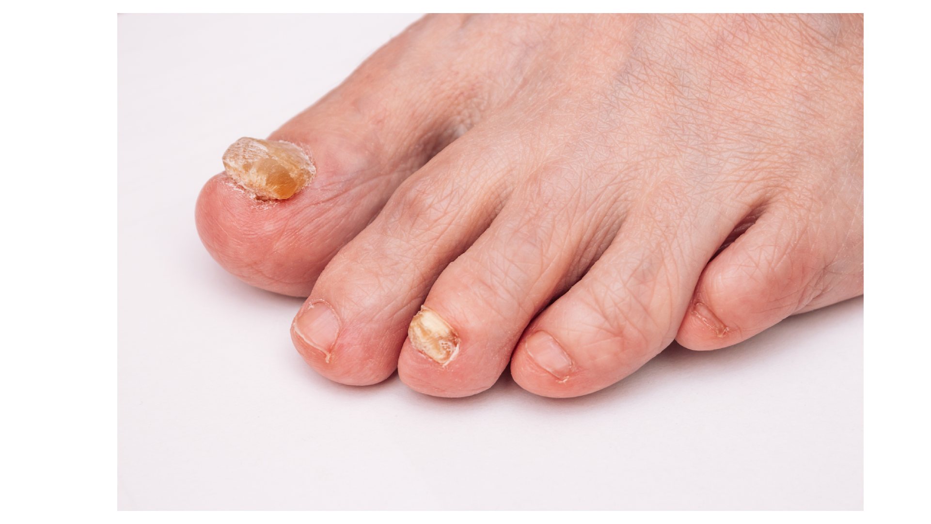 Mantar Hastalıkları